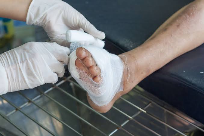 Clinical image of a non-healing wound on the lower leg being assessed for underlying circulation problems
