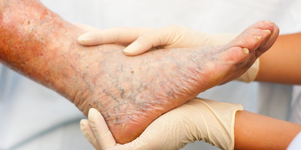 The Different Stages Of Varicose Veins