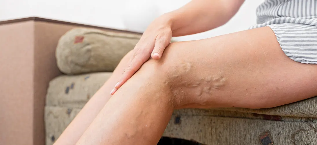 How Much Does Spider Vein Treatment Cost In 2025?
